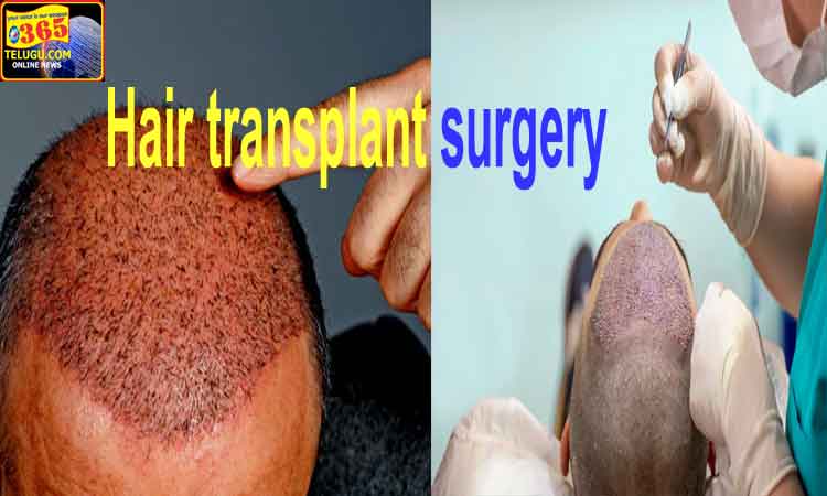 hair-transplant-surgery