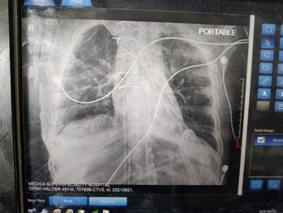 Bengal attains new milestone by successfully conducting Eastern India’s first lung transplant